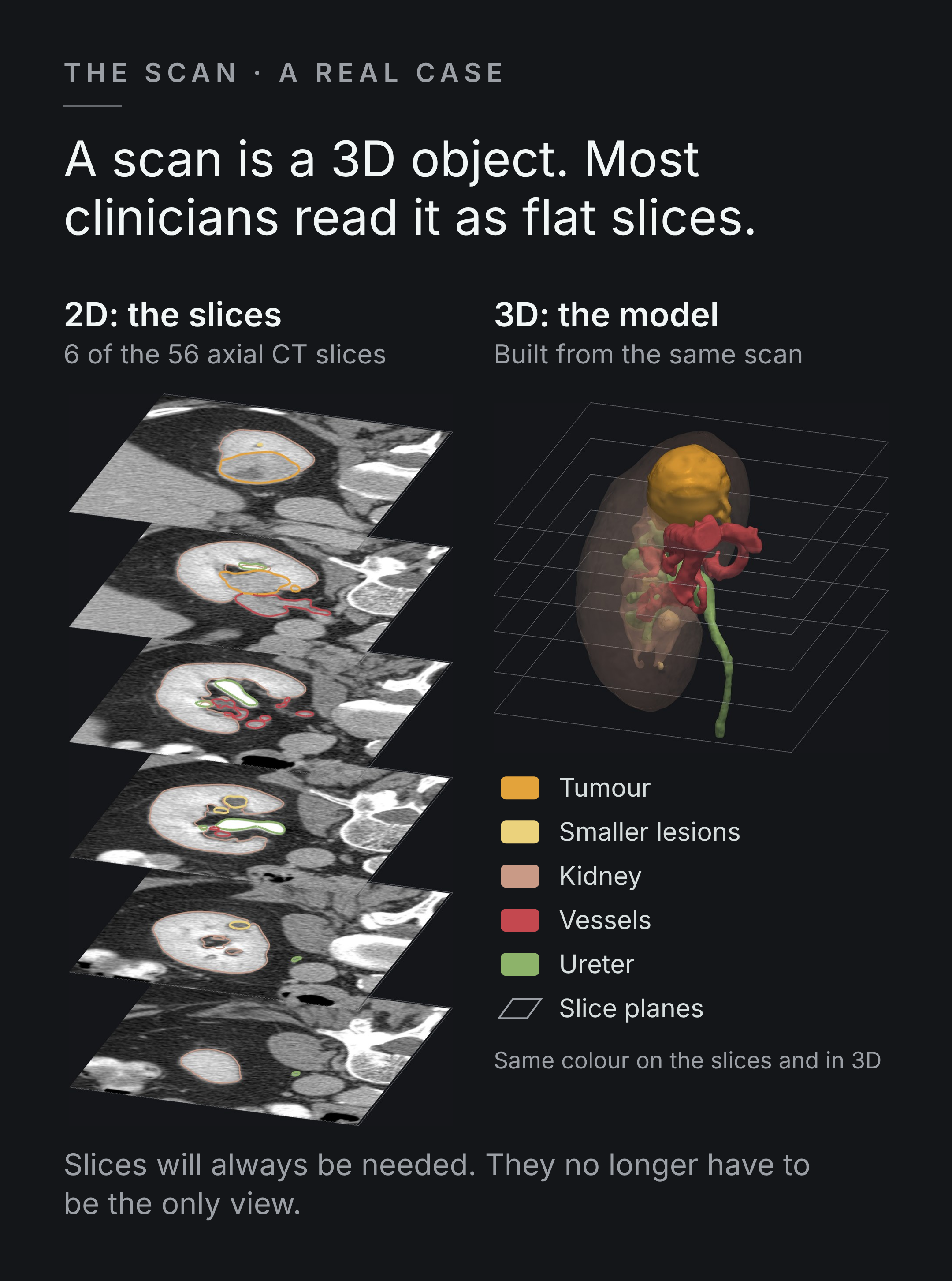 Six axial CT slices from one de-identified kidney CT, fanned out as a stack with each structure outlined in colour, beside the 3D model built from the same scan in the same colours: kidney (tan), tumour (amber), smaller lesions (pale yellow), vessels (red) and ureter (green), with the six slice planes drawn through it from the same viewpoint.
