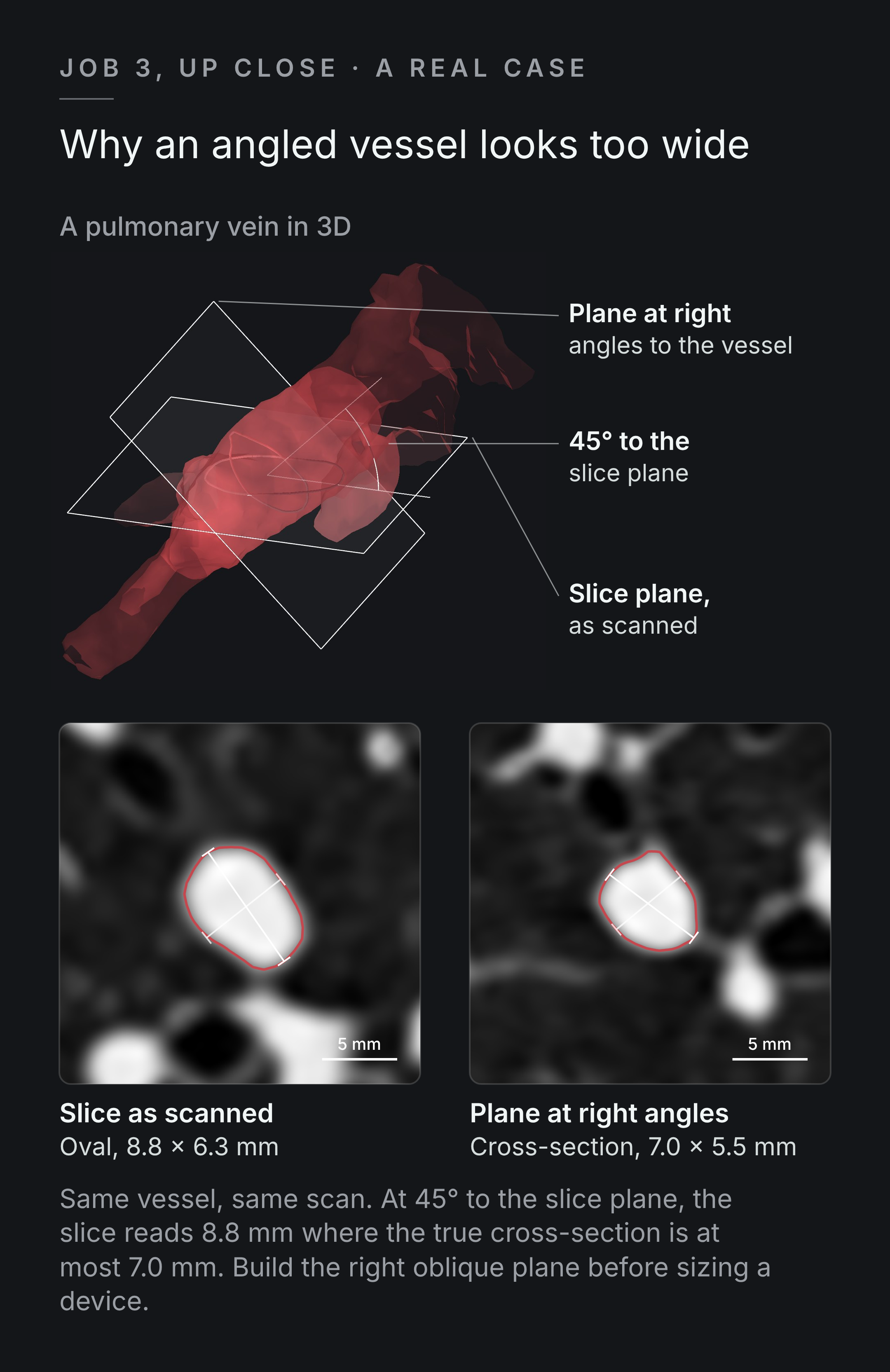 From one de-identified chest CT: a pulmonary vein running at 45 degrees to the scanner's slice plane, shown in red in 3D with both planes. On the slice as scanned its cross-section is an oval 8.8 by 6.3 mm; on a plane at right angles to the vessel it is 7.0 by 5.5 mm. Both outlines are traced from the CT intensities at half maximum.