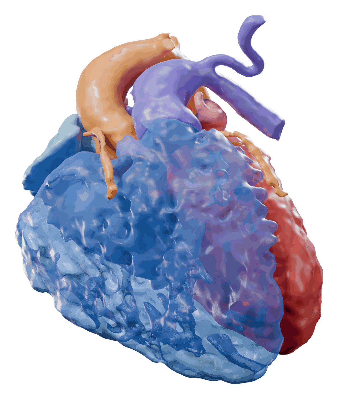 3D model of a child's heart with complex congenital anatomy, seen from the front and left. The right ventricle is see-through blue with the red left ventricle behind it, and the orange aorta and violet pulmonary arteries both rise from the right side of the heart.