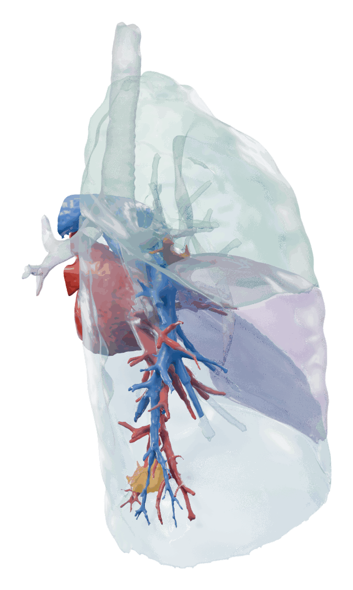 3D model of a right lung seen from behind and to the side. The upper, middle and lower lobes are see-through in mint, lilac and sky blue; blue pulmonary arteries and red pulmonary veins branch down into the lower lobe, where a small amber tumour sits among the branches.